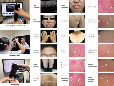 Sub-macroscopic skin presentation of acromegaly and effect of pituitary tumor surgery: A study using dermatoscopy and ultra-high-frequency ultrasound